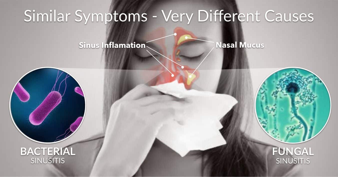 Learn About Chronic Sinusitis And Sinus Inflammation Caused By Mold